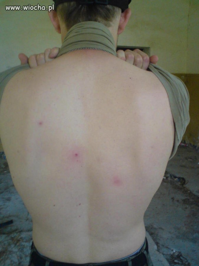Oh tak..  lans na pryszcze na plecach