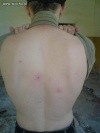 Oh tak..  lans na pryszcze na plecach