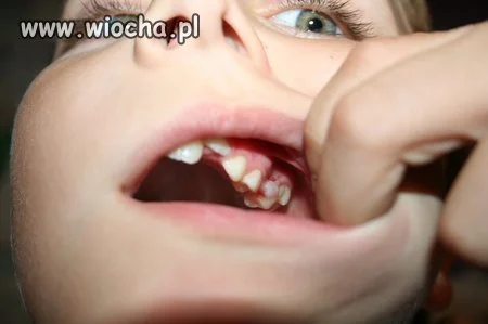 Usta pełne próchnicy