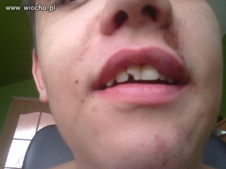 Chwali się że pół zęba nie ma