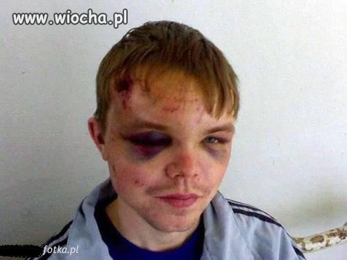 Nowa moda na wstawianie fotek z obitym ryjem 