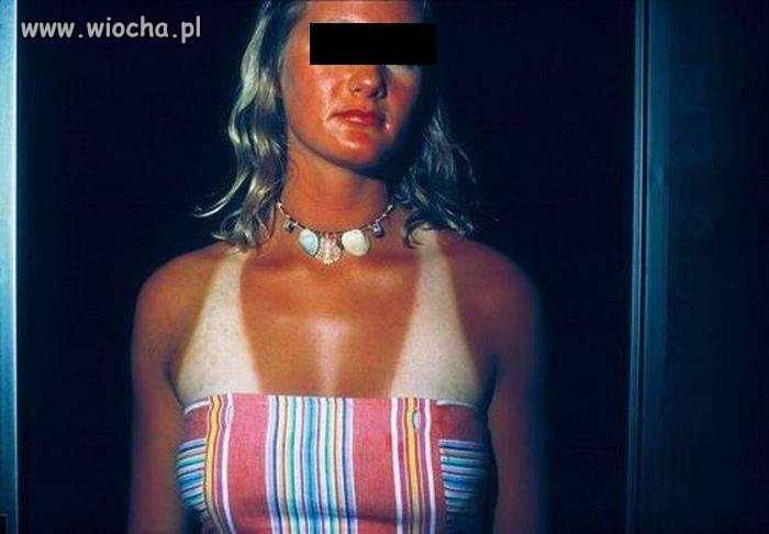 Skutki długiego przebywania na słońcu