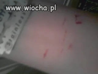 No naprawdę ostro się pociął ...