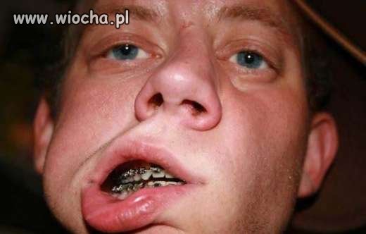 Aprat na wyprostowanie ząbków
