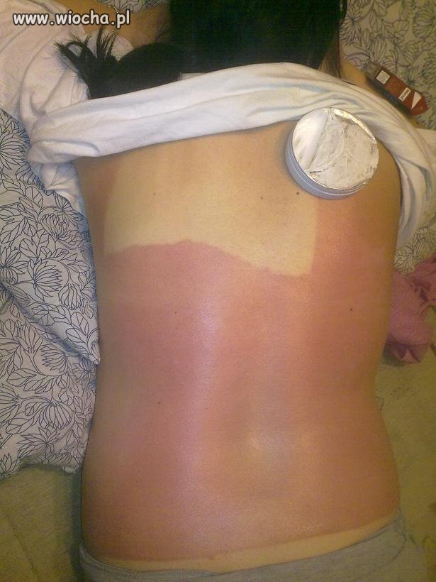 Skutki po solarium