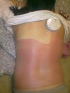 Skutki po solarium