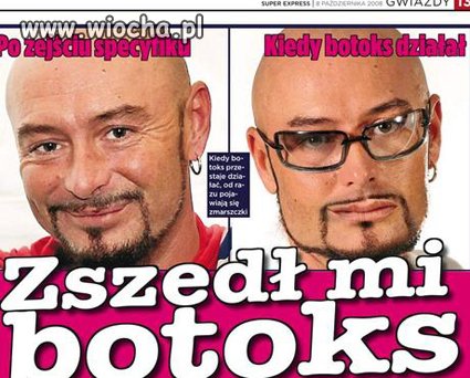 Zszedł mi botoks