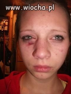 Dostała w mordę i musi pochwalić się na nk