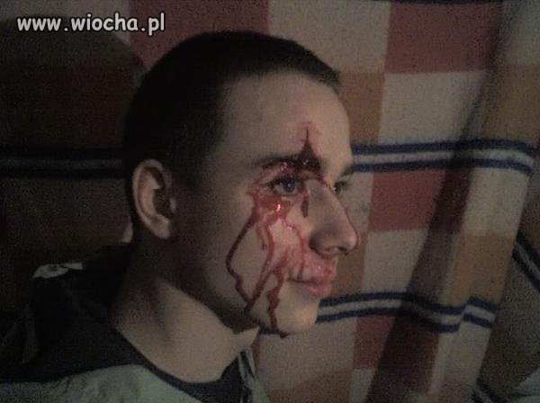Trzeba się pochwalić zbitym ryjem.
