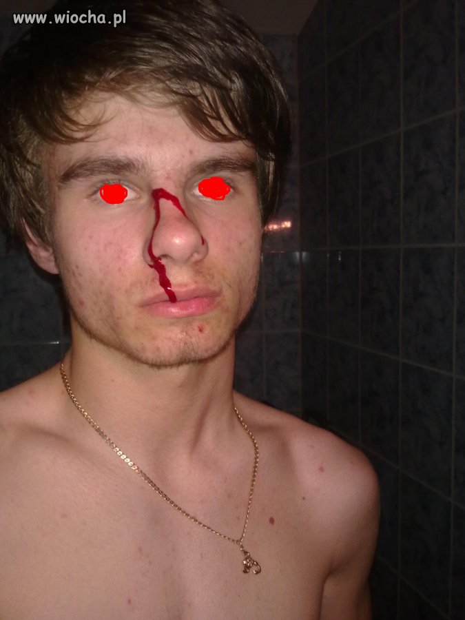 Rozdrapałem pryszcza