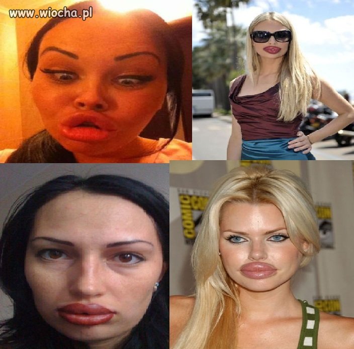 BOTOX + głupota = efekt kaczki 