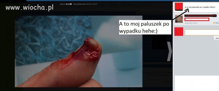 "A to mój paluszek po wypadku hehe"