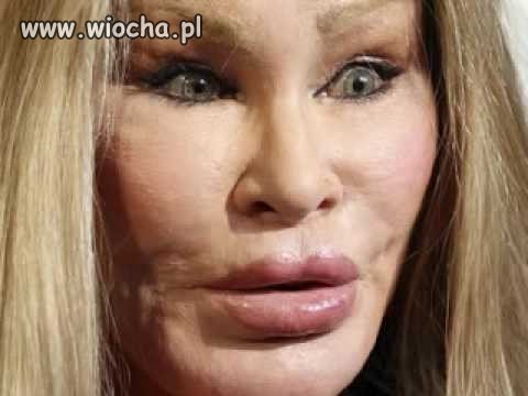 A mówili że botox upiększa...