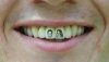 1000 baksów i 6 godzin na fotelu dentystycznym.
