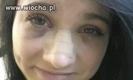 Masz rozwalony nos?