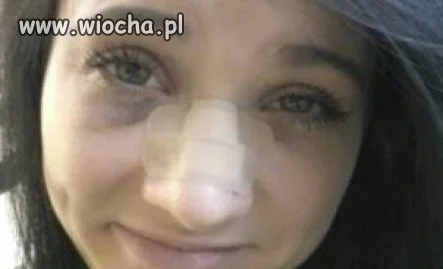 Masz rozwalony nos?