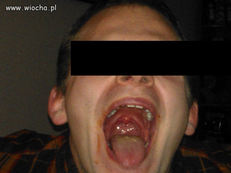PO LIZANIU