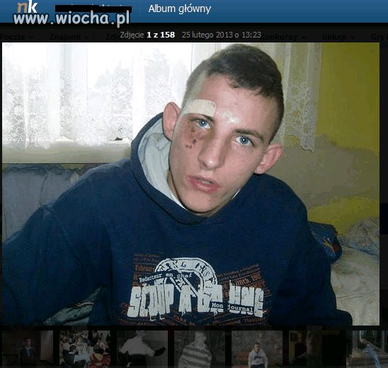 Lans na podbite oko. Po co takie fotki wrzucać ??