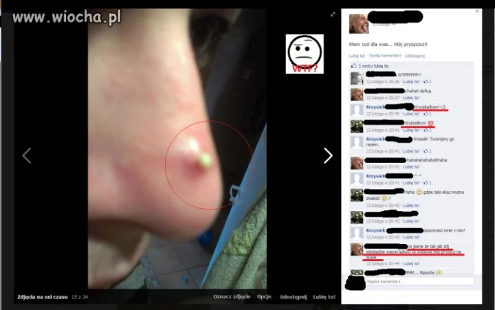 Takie tam zdjęcie pryszcza na fb ! 