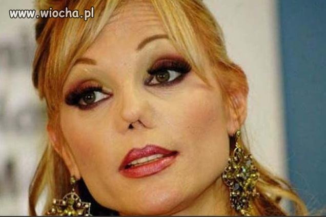 Skutki "plastyki" wykonanej przez fachowca.