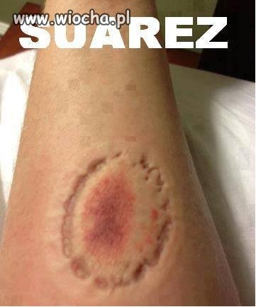Ślad po ugryzieniu przez Suarez'a