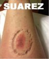 Ślad po ugryzieniu przez Suarez'a