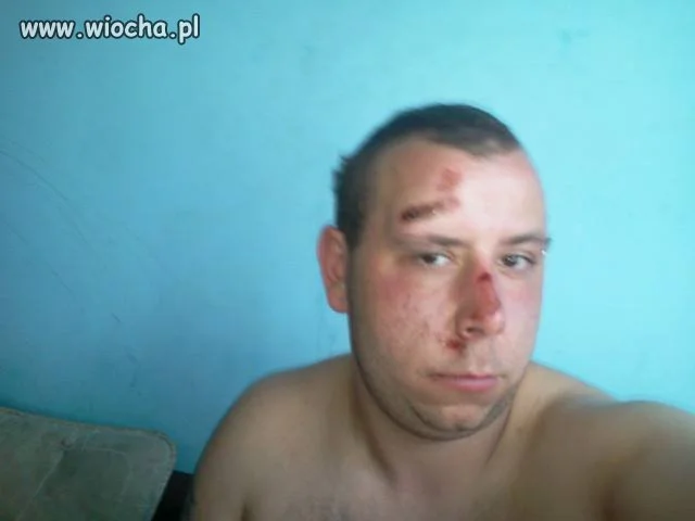 Troszke buźkę sobie starł