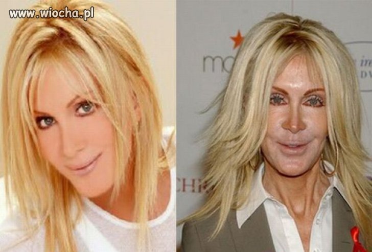 Joan Van Ark przed i po operacjach plastycznych