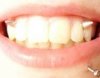 Piercing w zębach..