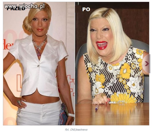 Operacje plastyczne PRZED i PO 