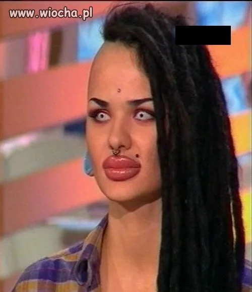 Botox