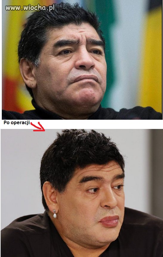 Maradona po operacji plastycznej