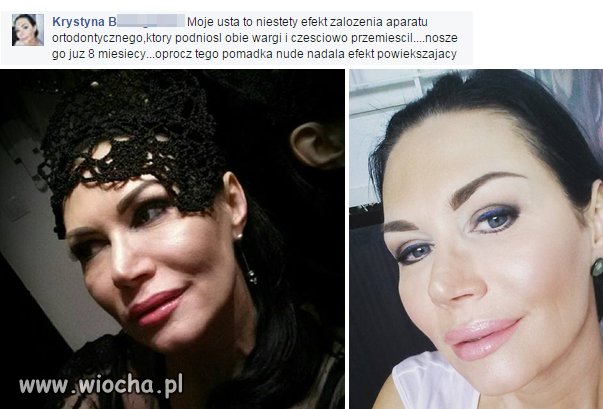 APARAT ORTODONTYCZNY ZDZIAŁAŁ CUDA!