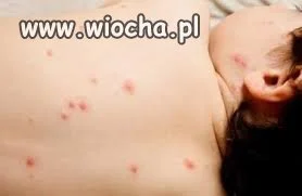 Półtoraroczne dziecko zmarło po ospa-party