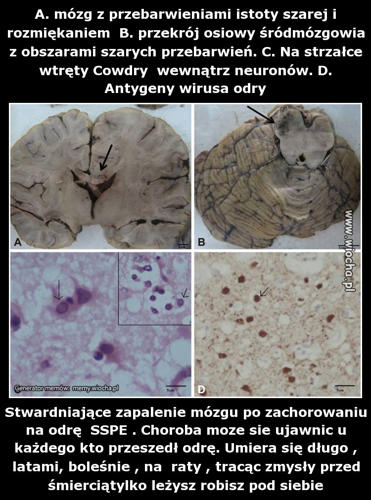 Mózg w trakcie sekcji 15 latka