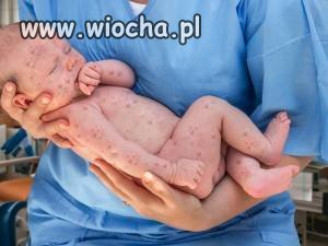 Rekordowa liczaba zachorowań na odrę w Europie