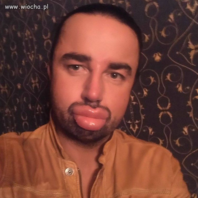Botox wersja męska