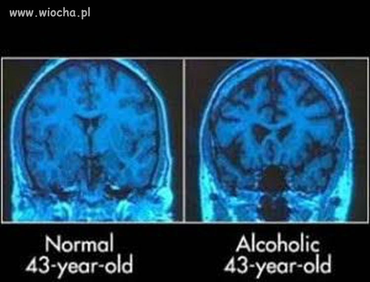 Mózg normalnego człowieka i alkoholika.