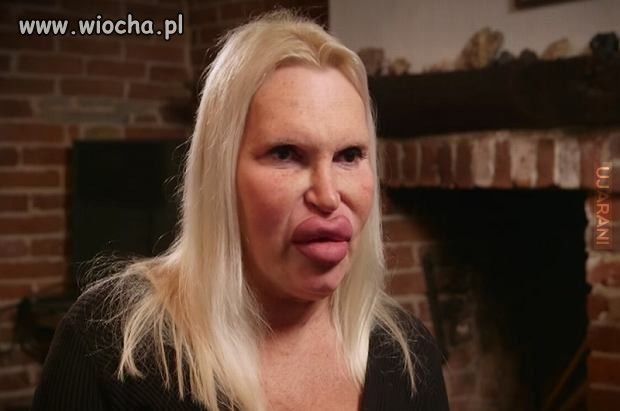 To nie fake ale "piękno" botoksu
