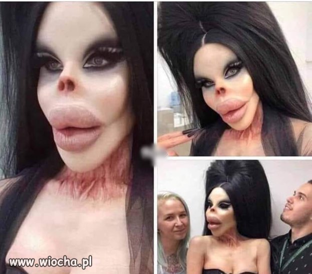 17 operacji
