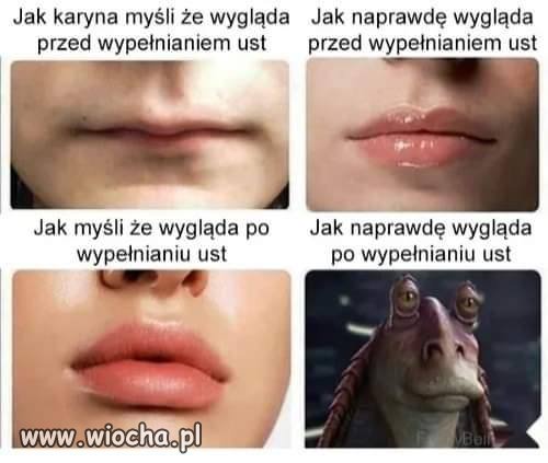 Karyna po wypełnieniu ust 