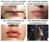 Karyna po wypełnieniu ust 