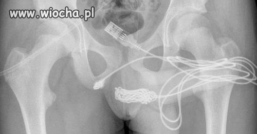 15-latek próbował zmierzyć przyrodzenie kablem USB.