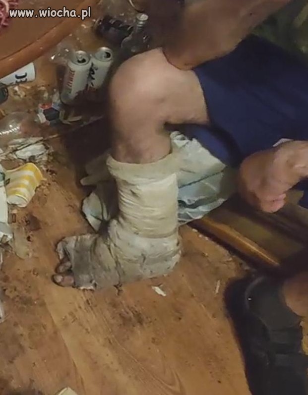 Iść żeby gips zdjęli z nogi 