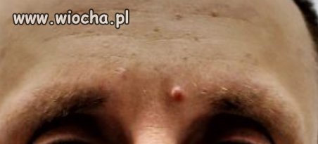 Kiedy masz przepuklinę mózgową